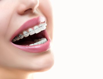 VOUS PORTEZ DES BROCHES DENTAIRES? VOICI 3 CONSEILS POUR DES SOINS D’HYGIÈNE EFFICACES!