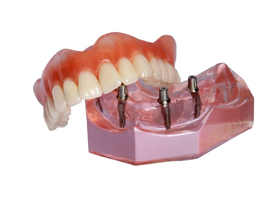 prothèse sur implants dentaires