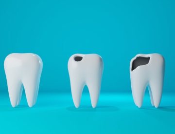 Carie dentaire : à traiter rapidement