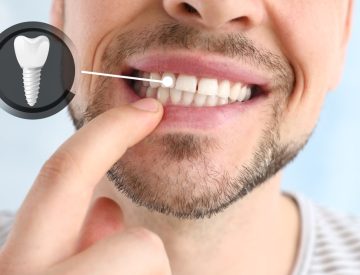 Implant dentaire : les bonnes raisons de le choisir pour remplacer une dent manquante