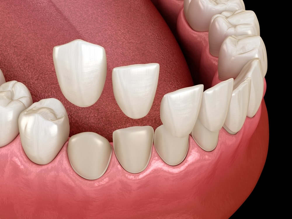 Installation de facettes dentaires sur les dents antérieures du bas