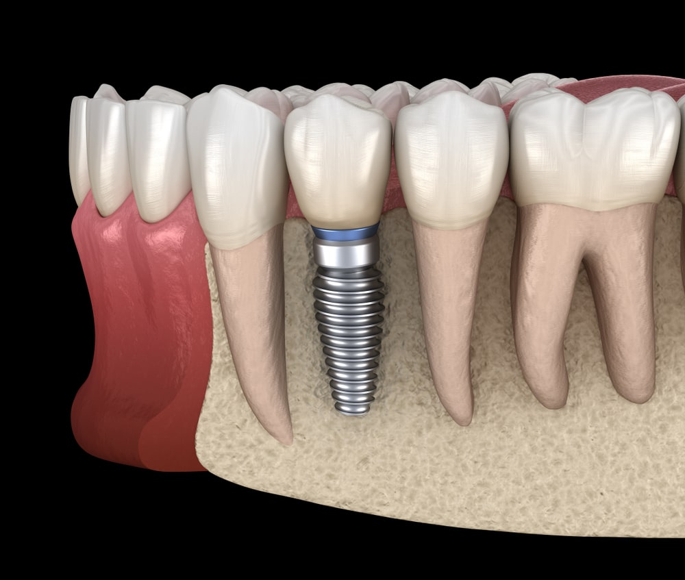 Illustration de l'ostéointégration d'un implant dentaire dans l'os de la mâchoire