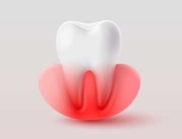Parodontite avancée : quelles solutions pour éviter la perte dentaire ?