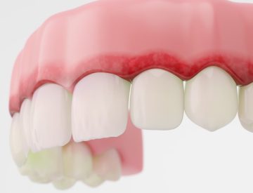 Parodontie et comorbidités : comprendre l’impact du diabète, du tabagisme et de l’immunosuppression