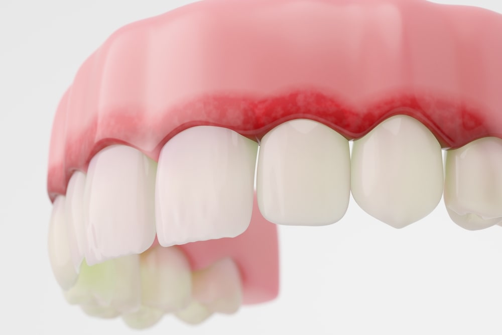 Illsutration 3D des maladies des gencives qui sont l'objet d'étude de la parodontie