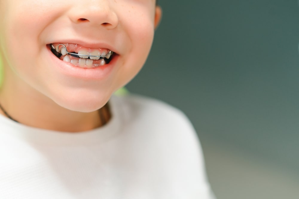Un garçon portant un appareil d'orthodontie myofonctionnelle