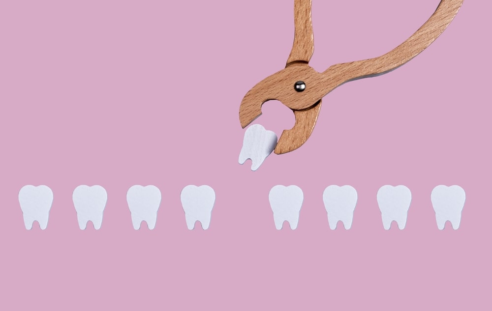 Concept d'extraction dentaire, laquelle peut mener à une alvéolite