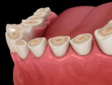 Usure de la dentition : comprendre l’attrition, l’abfraction et les causes invisibles