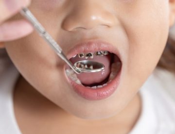 Carie de la petite enfance : petite carie, gros problèmes