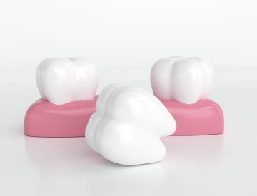 Même une seule dent manquante peut perturber l’équilibre de toute votre bouche