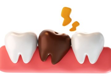 Dent qui noircit : ce que la décoloration peut révéler
