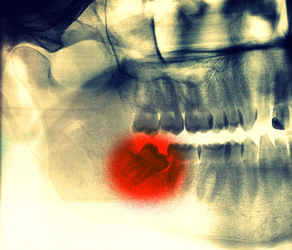 Radiographies montrant des dents de sagesse à extraire