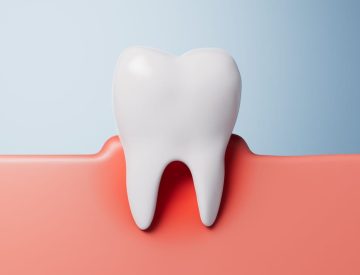 La maintenance parodontale : pourquoi revenir tous les 3 à 4 mois après un traitement ?