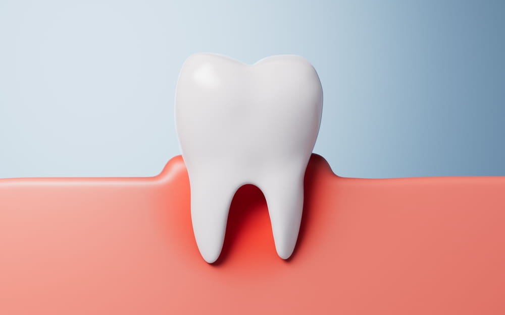Dent touchée par une parodontite, nécessitant une maintenance parodontale