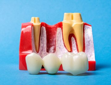 Pont dentaire ou implant : comment choisir la bonne solution pour remplacer une dent ?