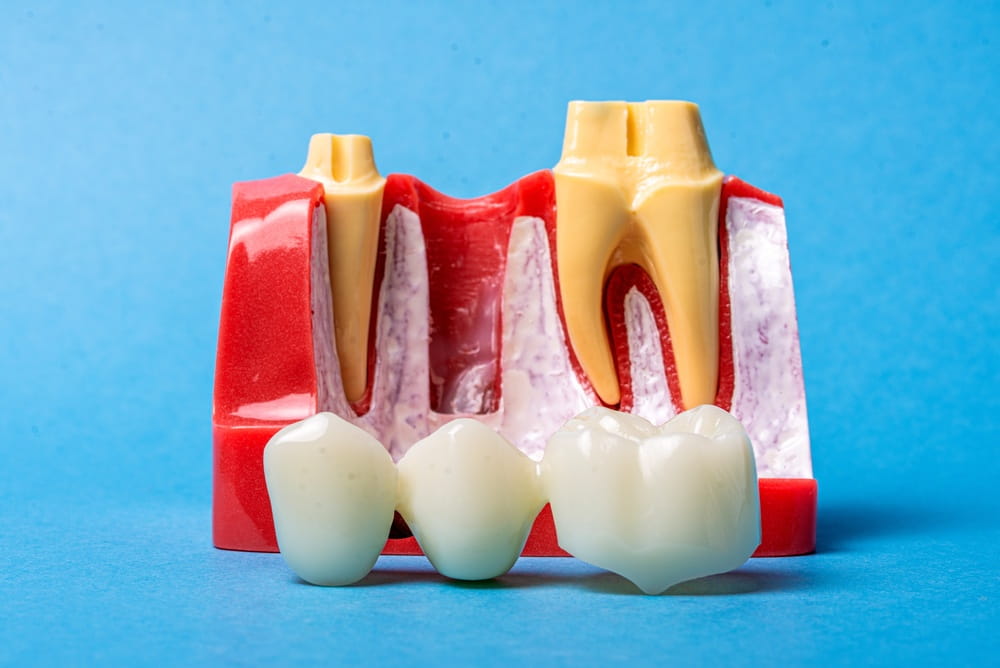 L'implant dentaire comme alternative au pont, illustré ici