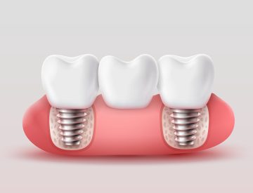 Les solutions de remplacement des dents manquantes avec les implants dentaires