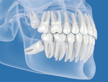 Extraction des dents de sagesse à l’âge adulte : est-ce trop tard ?