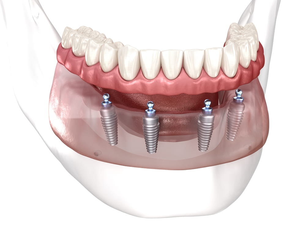 Illustration d'une prothèse sur implants, avec 4 implants dentaires